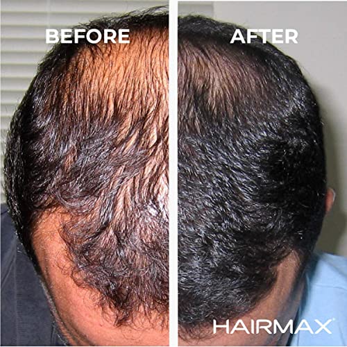 HairMax Lazer Saç Büyüme Bandı LaserBand 82 (FDA Temizlendi). Erkekler ve kadınlar için Saç Büyümesini Uyaran, İncelen Saçları